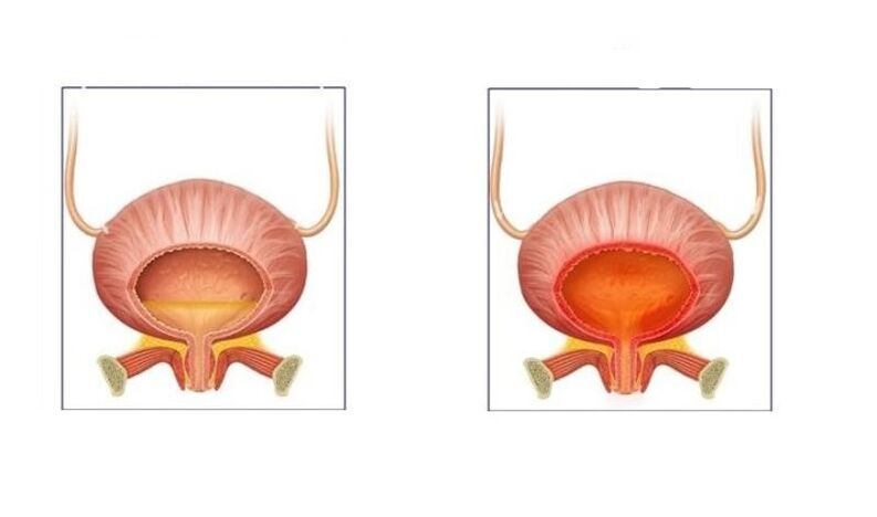 Нормални и пациенти с цистит на пикочните пътища