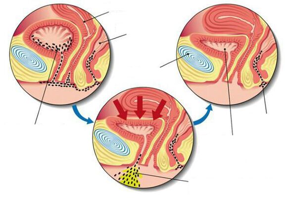 бактерии в пикочния мехур с цистит