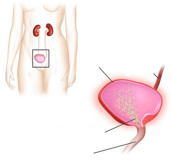 възпаление на пикочния мехур